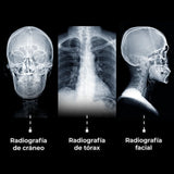 Rayos X Portátil 5kw con batería recargable. Modelo DRX3.2